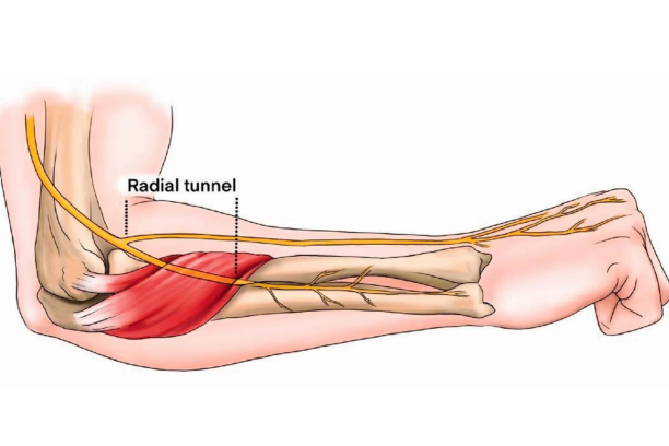 Radial Tunnel Syndrome